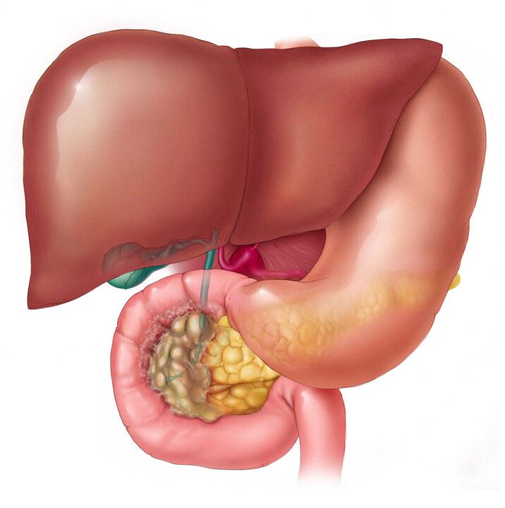 How to remove parasites from liver