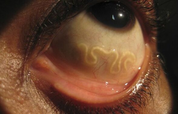 Loa Loa worms live in human eyes and cause blindness